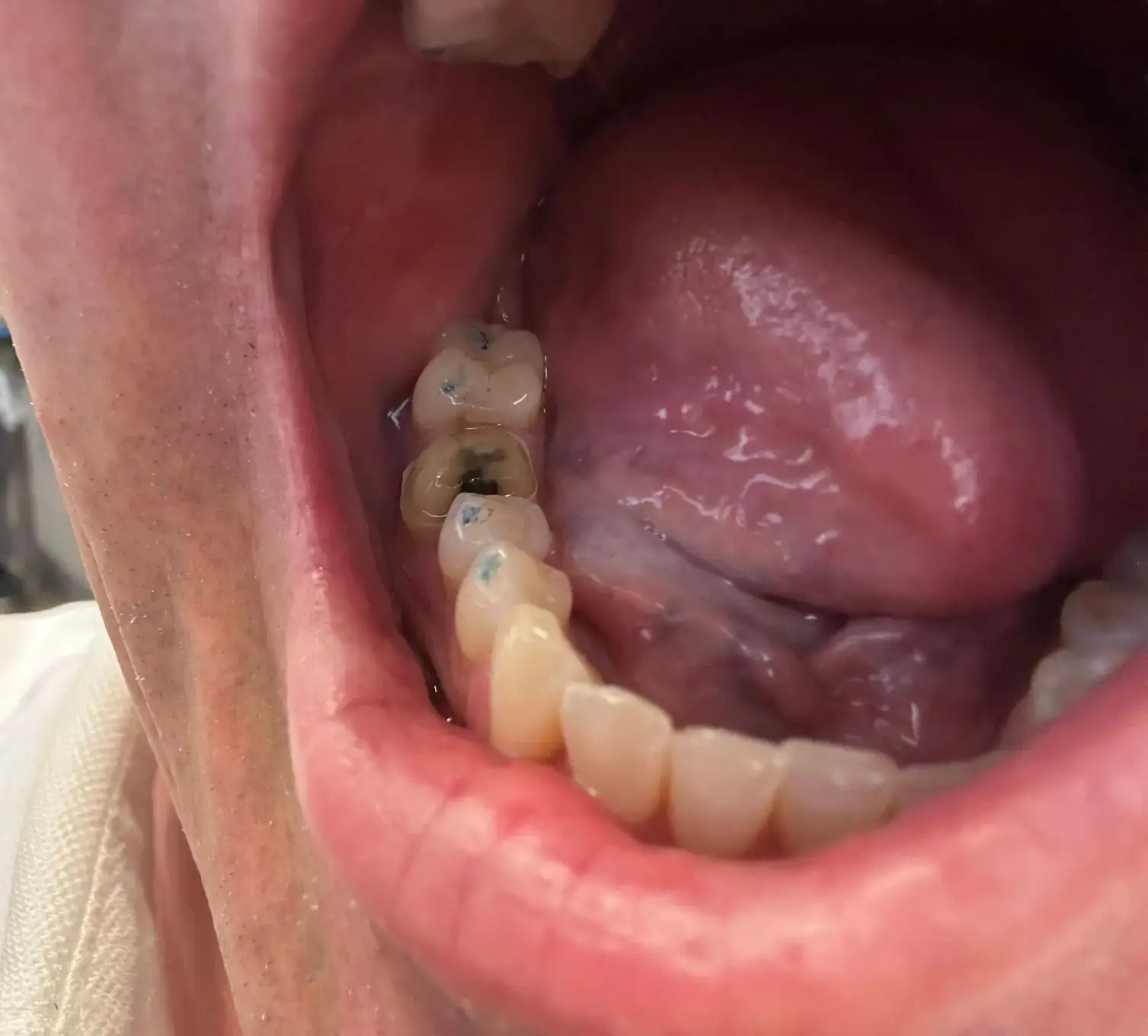 photo analysis right side teledentistry