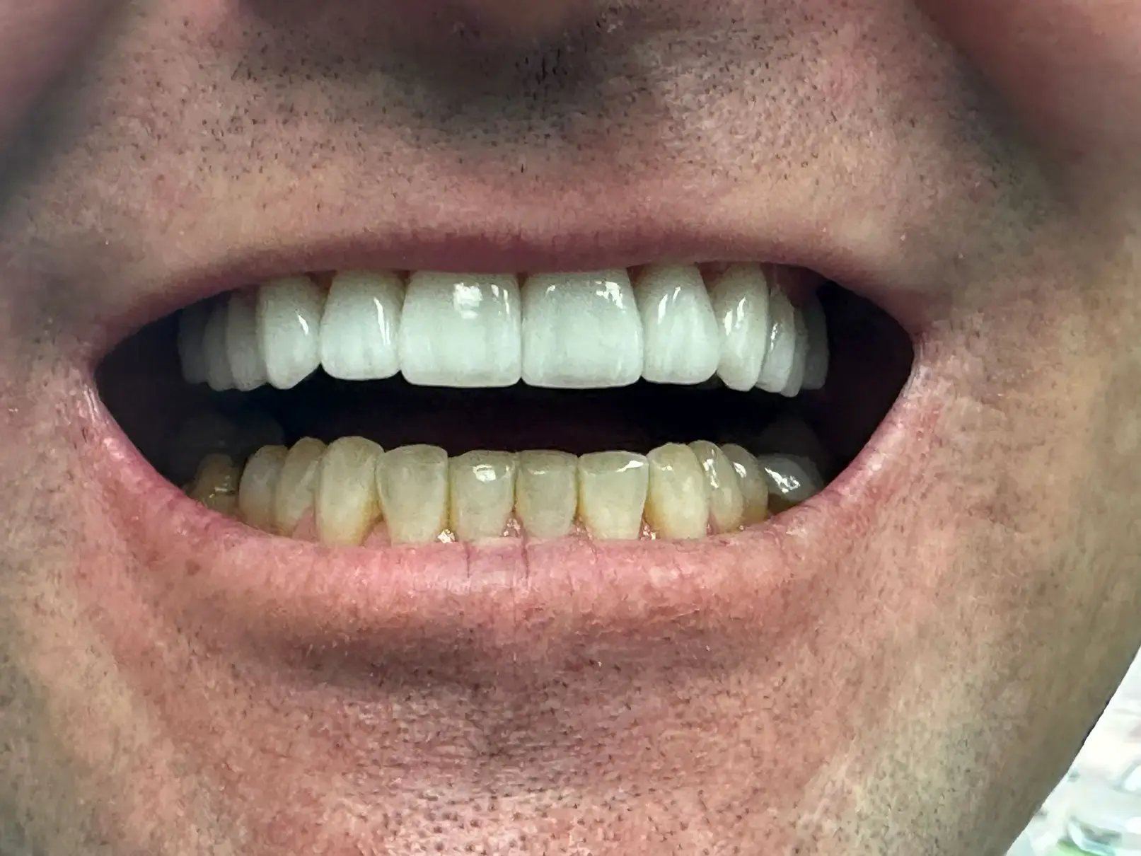 front facing open mouth photo analysis teledentistry