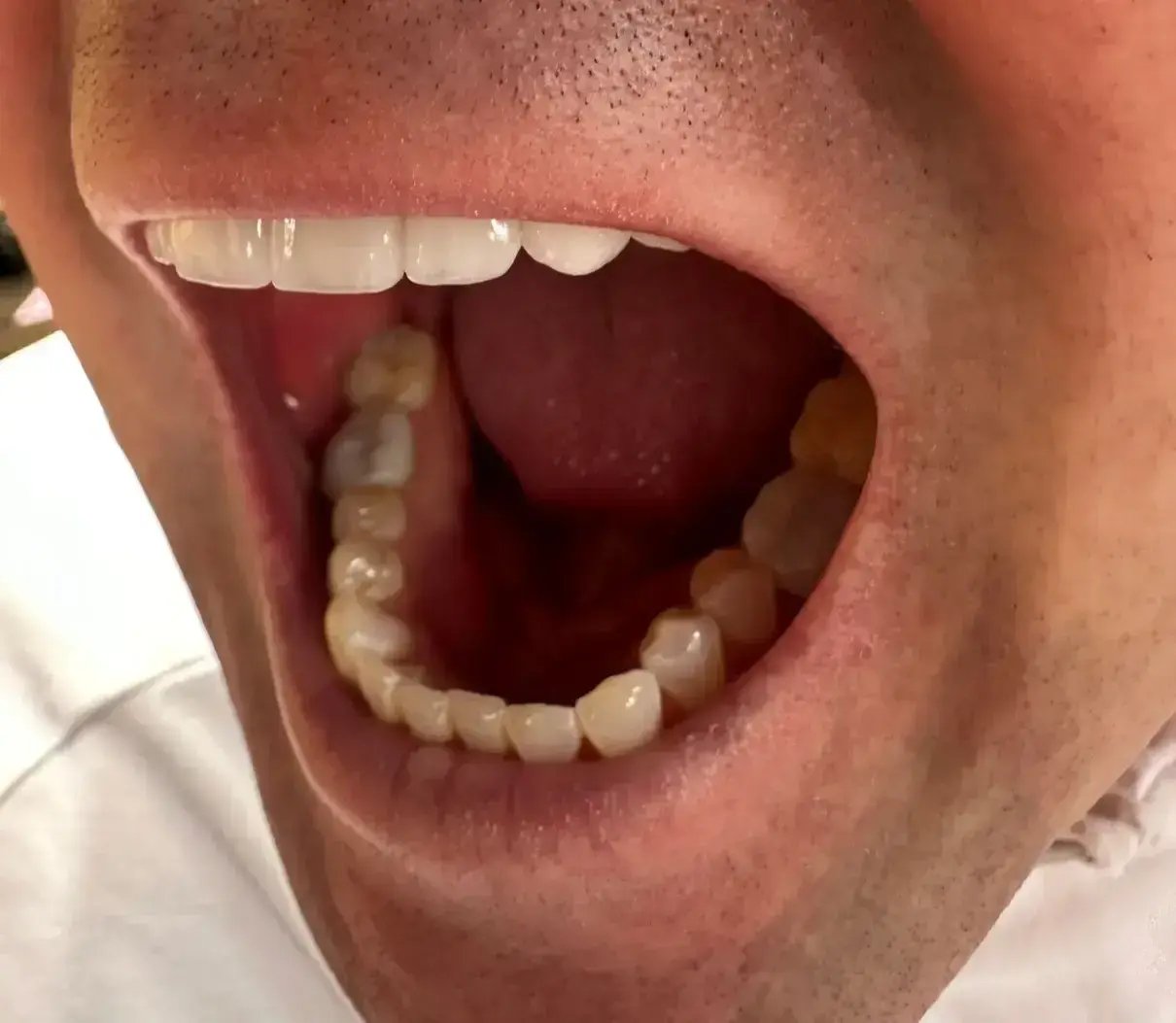 left side of mouth photo analysis teledentistry