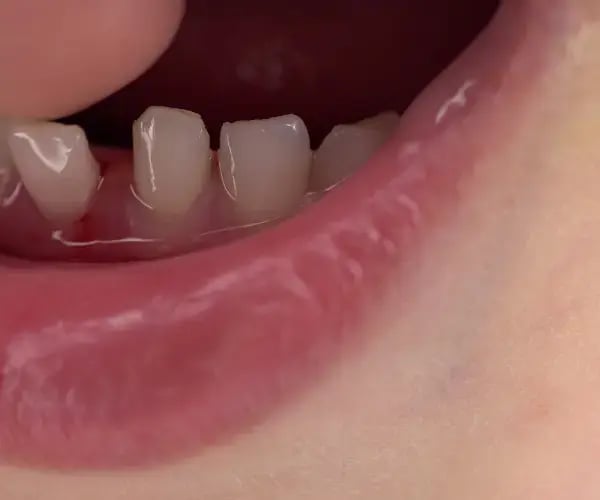 loose teeth