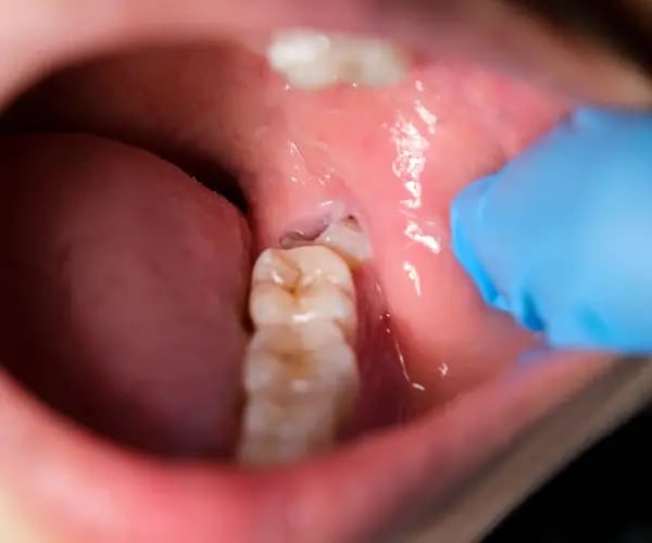 wisdom tooth