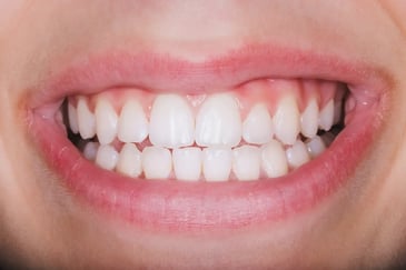 Fluoride treatment on teeth-teledentistry