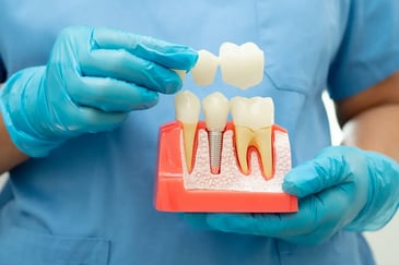 dental bridges-teledentistry