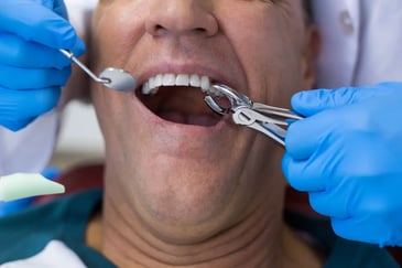 Tooth Extraction