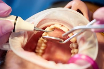 dental plaque teledentistry