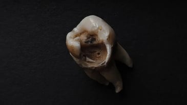 Tooth Decay image