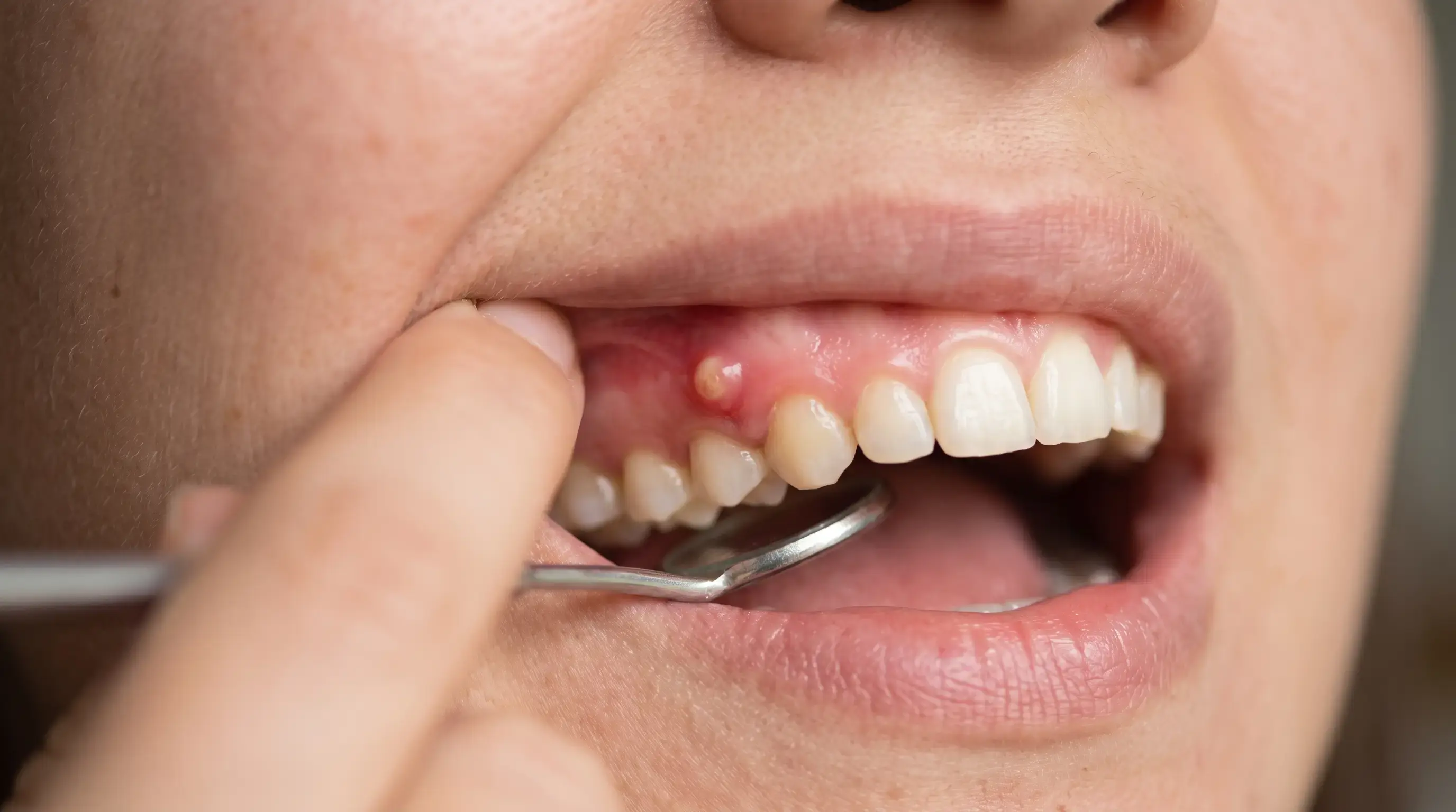 Close-up of a person's open mouth showing a red, swollen gum boil on the lower gums.